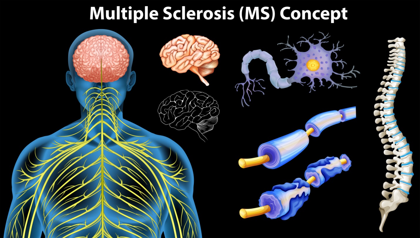 Multiple Sclerosis Treatments