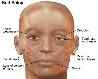 What is Facial Palsy?