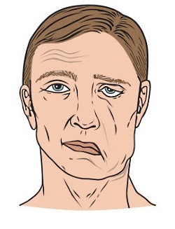 What is Facial Palsy?