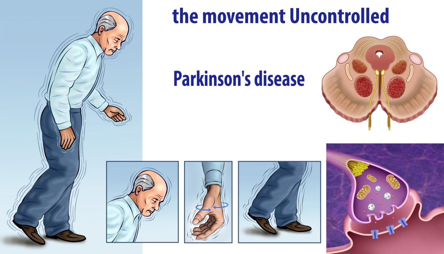 What Causes Parkinson's Disease